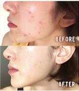 ハワイで全身アンチエイジング シミに効果的な美容サロン ホワイトタンニング